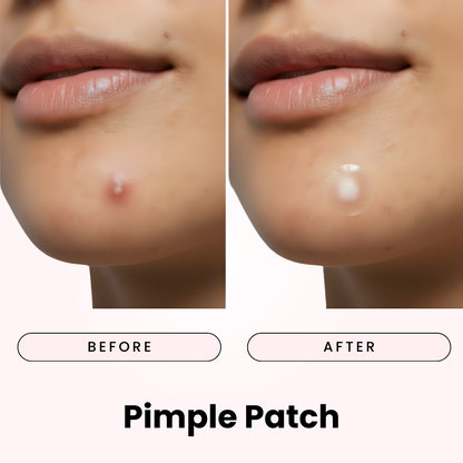 Patchs Anti-Boutons Hydrocolloïdes Invisibles - Anti-Acné & Anti-Imperfections visage